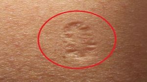 Ai si tu acest semn pe brat? Uite care este adevarata lui semnificatie - Apare de obicei la cei care au mers la medic inainte de Revolutie