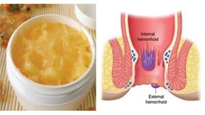 Simptomele dureroase ale hemoroizilor. Cum sa scapi de probleme cu un tratament naturist miraculos