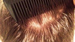 Ce inseamna cand visezi paduchi