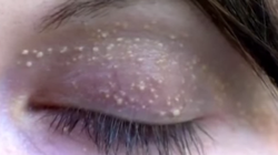 Iti apar puncte albe multe in jurul ochilor? Ce sunt ele, de fapt, si de ce afectiune suferi