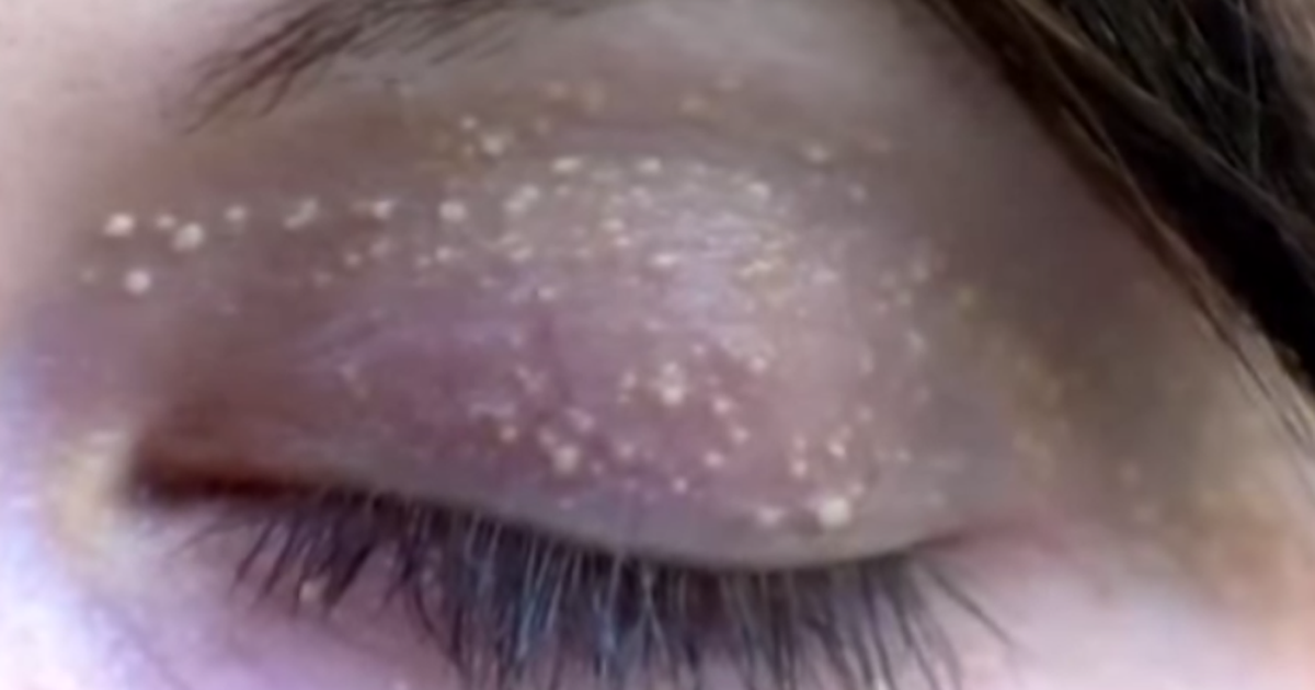 Cum Sa Scapi De Herpes Repede