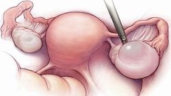 Ai putea avea chisturi ovariene fara sa stii! Fii atenta la aceste simptome