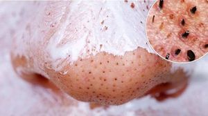 Cea mai eficienta reteta care te scapa de punctele negre