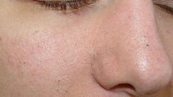 Remediu natural pentru pori incarcati si puncte negre! Ai nevoie de un singur ingredient