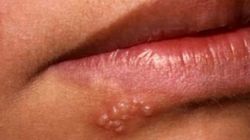 Cele mai bune remedii pentru herpes! Sigur le ai si tu in casa