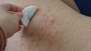 Iti apar cosuri pe spate si brate? Mare atentie, ai putea suferi de aceasta boala