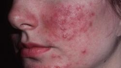 Leacuri băbeşti pentru acnee care dau rezultate