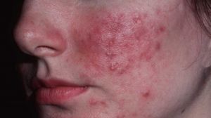 Leacuri băbeşti pentru acnee care dau rezultate