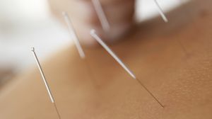 Acupunctura si beneficiile ei!