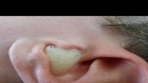 Şi-a pus oţet în ureche, iar ce s-a întâmplat e absolut incredibil! Trebuie să încerci şi tu