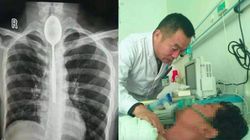 Chinezul care a trăit timp de un an cu o lingură în esofag
