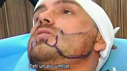 Vladau si-a facut implant de par pe scalp si in zona barbii