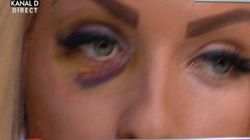 Loredana Chivu, talharita in scara blocului! A fost batuta in ultimul hal! Uite cum arata acum! Are ochii invinetiti!