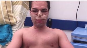 A vrut sa se transforme in papusa Ken, dar operatiile estetice l-au distrus! Acum are o gaura in nas si arata HORROR! novalue