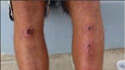 Cum  arata de fapt picioarele lui Alex Bentita de la Exatlon! Imaginea ingrijoratoare care tocmai a fost facuta publica