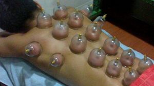 Dumnezeule! Si-a pus ventuze pe spate insa dupa ce le-a scos a ramas mutilat! N-o sa mai incerce asta cate zile va avea! Imagini care te vor soca! novalue