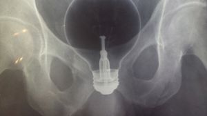 TOPUL celor mai pacatoase ecografii! Medicii au ramas fara grai cand au vazut ce si-au putut indesa oamenii astia in ei! Radiografia cu borcanul e cea mai tare novalue