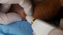 Avea o GALMA pe gat de multi ani si a decis sa mearga la medic! E ingrozitor ce a iesit din ea! Pana si doctorii au fost socati