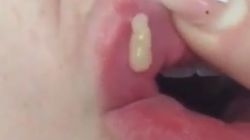 Si-a marit buzele la oferta, insa a avut un soc peste cateva zile! Chiar si medicii au fost uimiti cand au vazut ce-i iese din buza