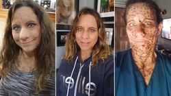 Femeia cu peste 6000 de tumori s-a operat! Transformarea e uimitoare