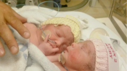 Medicii le acordau șanse minime de supraviețuire! Iată cum arată gemenele siameze Robie și Rosy,  după șapte ani de la operația de separare