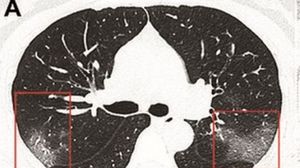 Coronavirus. Este incredibil cât de rapid a acționat virusul în plămânii unei tinere infectate! Medicii au publicat radiografia