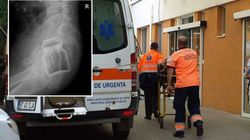 Un botoșănean a venit la spital cu un borcan băgat în posterior. Anul trecut a ajuns la spital, în aceeași zi, cu un pahar tot acolo