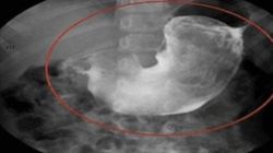 Avea dureri mari si a mers la ginecolog! Incredibil ce a gasit medicul in burta femeii