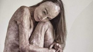 Carol Mayer, desfigurată de arsuri, a avut curajul de a poza nud