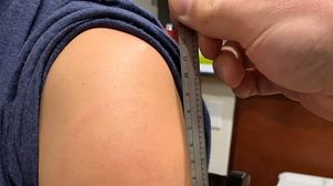 „Braţ Covid”, reacția adversă rară apărută după vaccinarea cu serul Moderna! Ce au declarat specialiștii