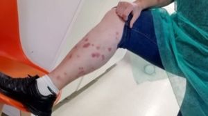 ploșnite, turistă, hotel, vacanță de coșmar, băile felix