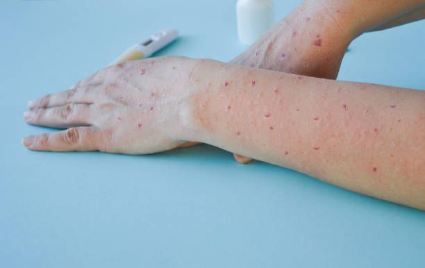 variola-maimuței-vaccin-alxandru-rafila