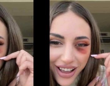 Bianca Giurcă a apărut vânătă la ochi! „Ce s-a întâmplat?”