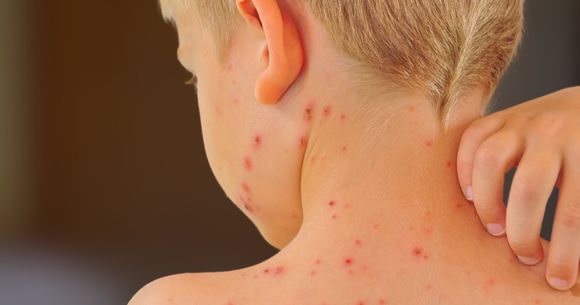 Este focar de rujeolă &icirc;n Europa. 