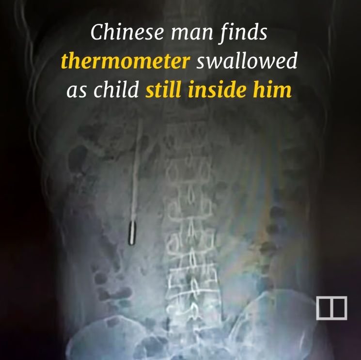 Un bărbat din China a ajuns la spital cu dureri abdominale, iar medicii au descoperit un termometru  cu mercur înghițit în copilărie