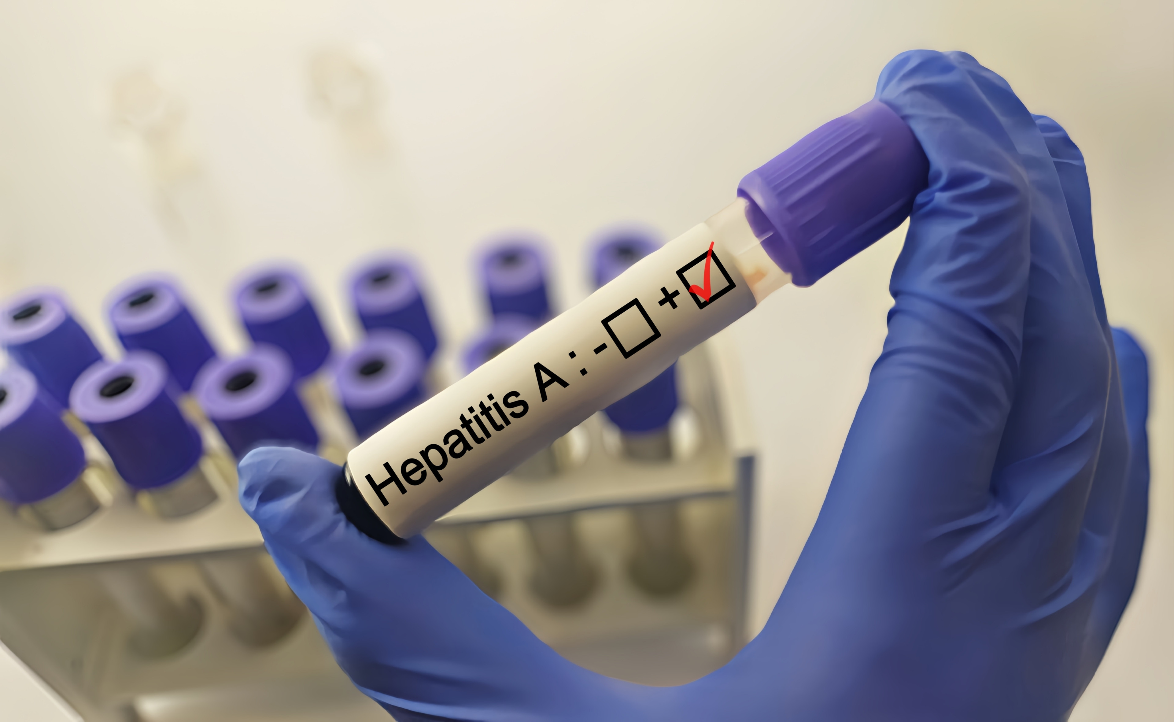 Alertă sanitară în Constanța! Au fost descoperite 23 de focare de hepatită A