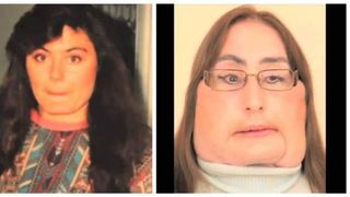 primul transplant de față