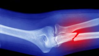 Otravă pură care îți distruge oasele. O bei în fiecare zi fără a ști cât de toxică este pentru organism