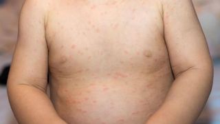 pandemie rujeolă pe glob