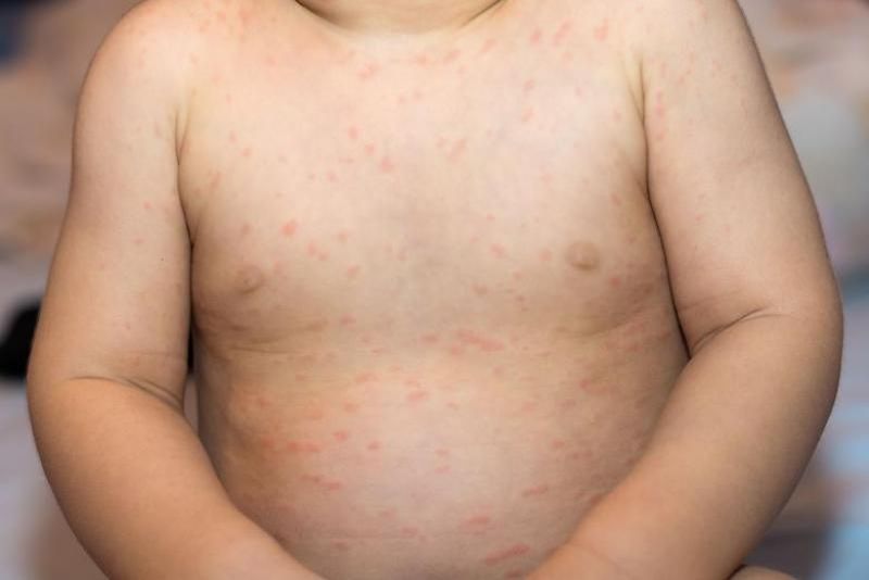 pandemie rujeolă pe glob