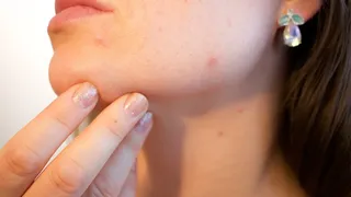 VIDEO-Probleme dermatologice pentru gravide de la modificări hormonale