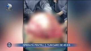OPERATĂ PENTRU O TUMOARE DE 40 DE KILOGRAME