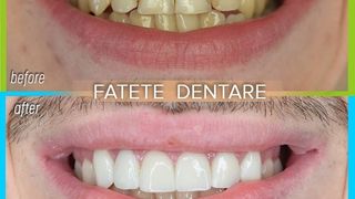 Tratamentul cu fațete dentare distruge dinții?