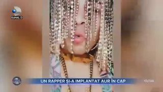 Un rapper și-a implantat aur &icirc;n cap
