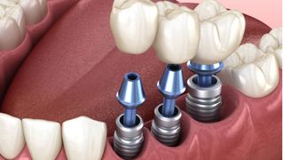 Află cum poți scăpa de frica de implant dentar!