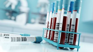 A fost descoperită o legătură între tulpinile noi SARS-CoV-2 și HIV netratat