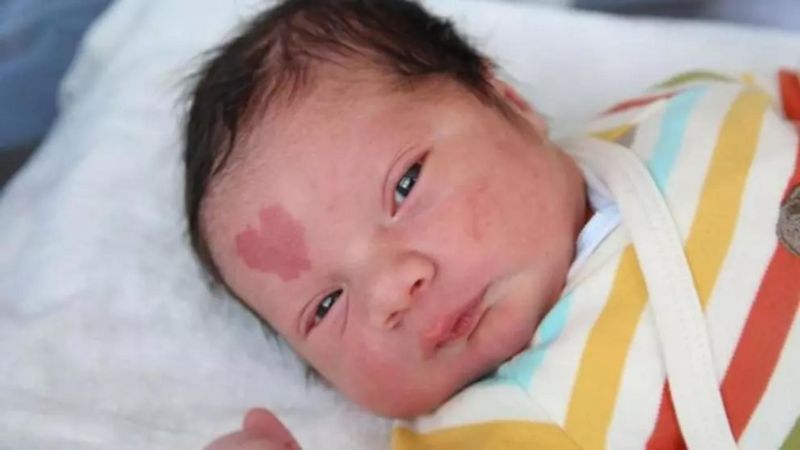 băiatul care s-a născut cu o inimioară în frunte