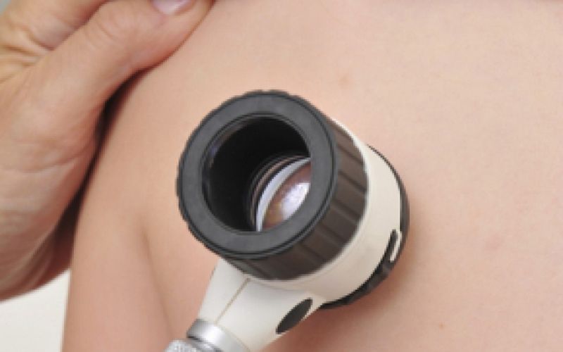 alunițele roșii de pe piele