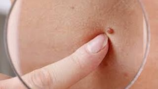 alunițele roșii de pe piele