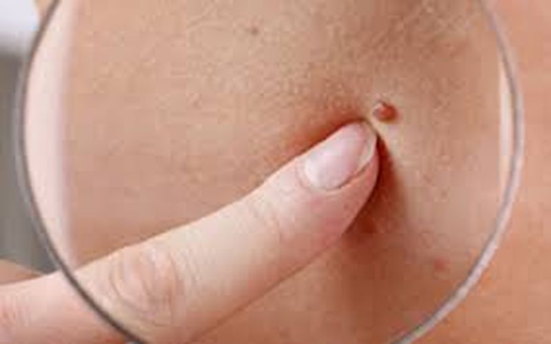 alunițele roșii de pe piele